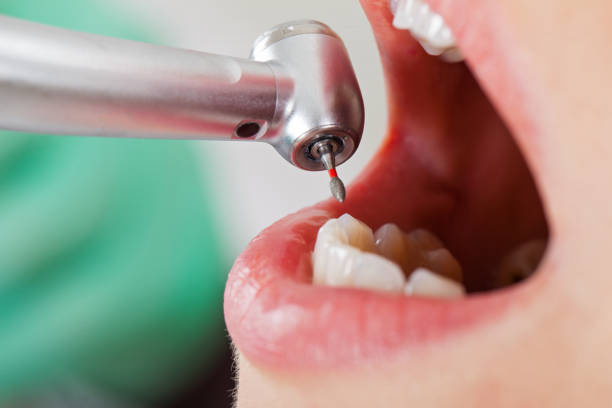 Best Chipped Tooth Repair Near Me  in Mason City, IL